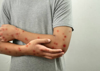 Salud Pública confirma dos casos de mpox en destacamento policial de San Cristóbal y mantiene vigilancia epidemiológica
