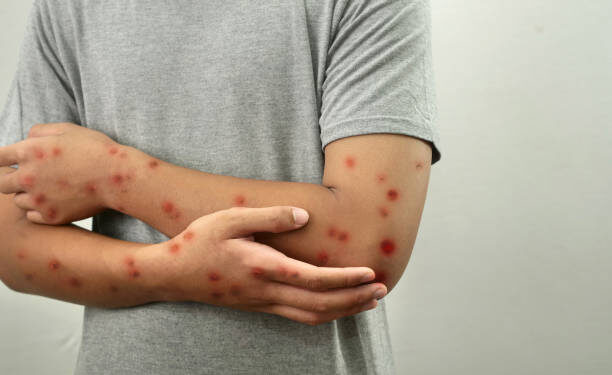 Salud Pública confirma dos casos de mpox en destacamento policial de San Cristóbal y mantiene vigilancia epidemiológica